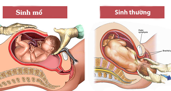/images/companies/benhvienducgiang/images/2026/tháng 4/180753-sinh-thuong-va-sinh-mo.jpg